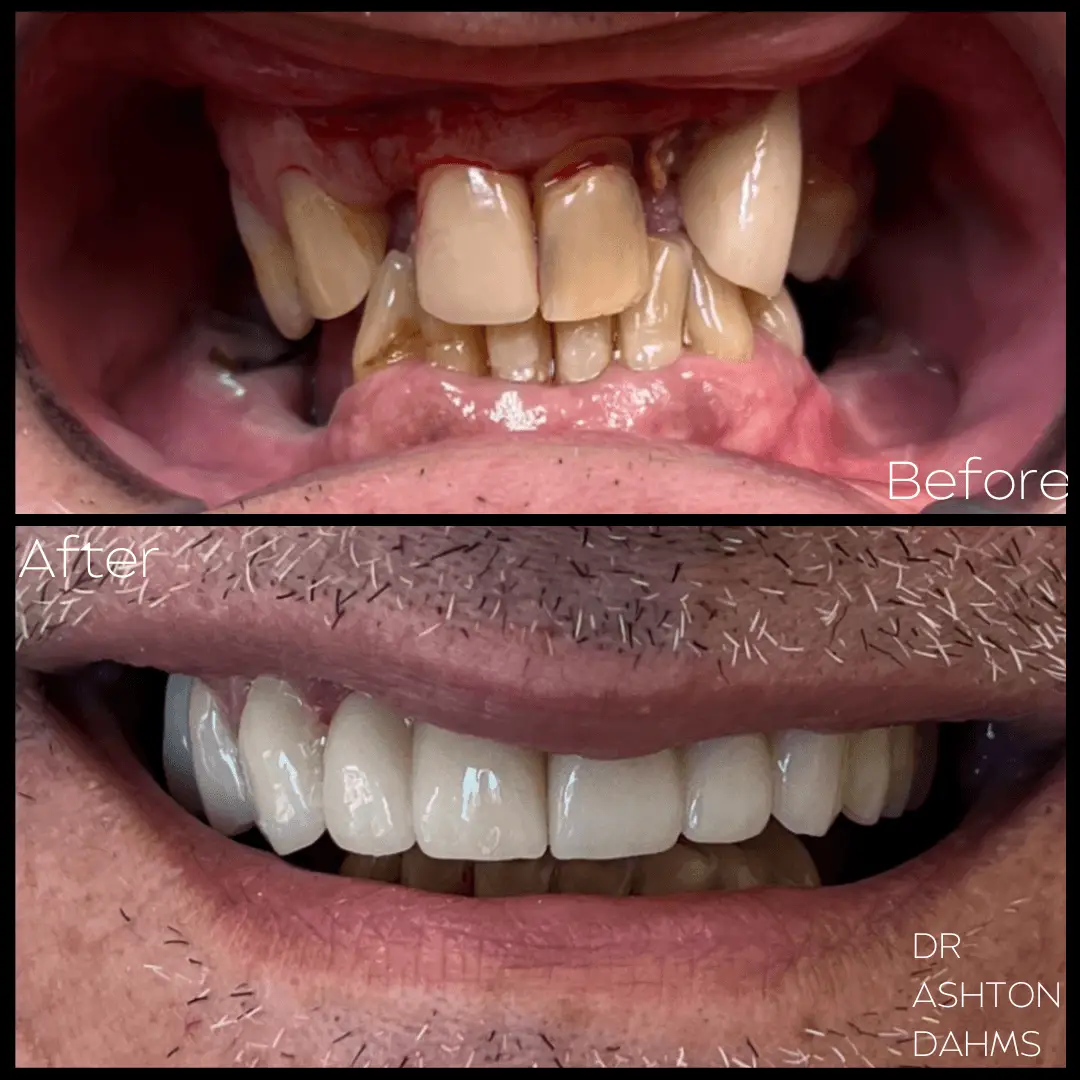 implants before and after 3 (1)