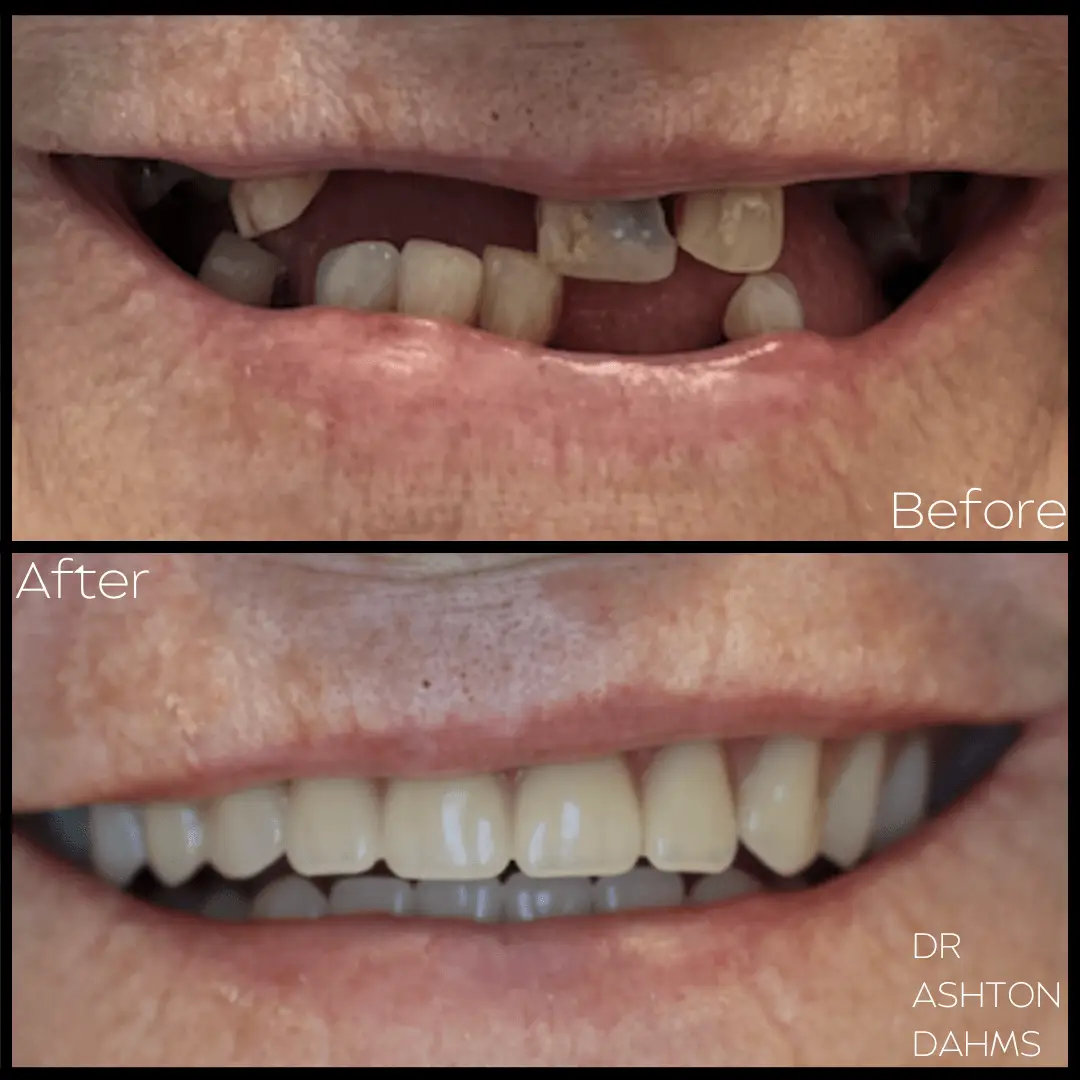 implants before and after 4 (1)