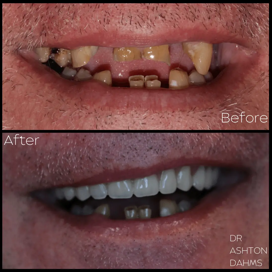 implants before and after 6 (1)